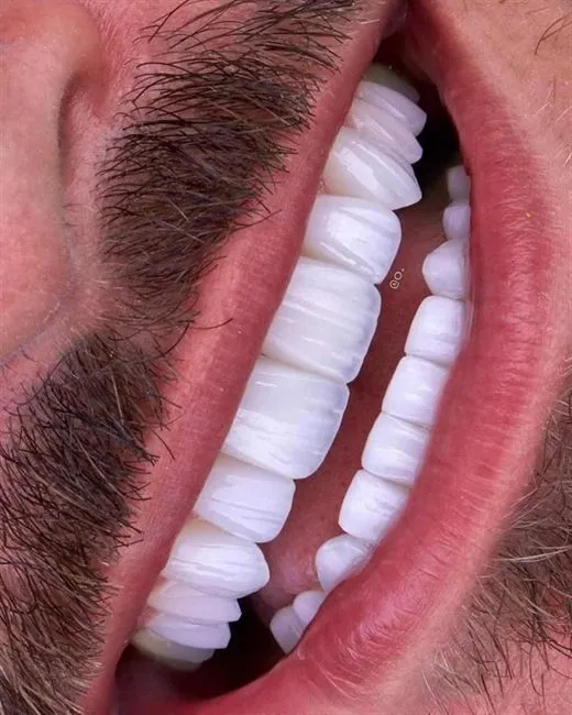 باقة زراعة الأسنان