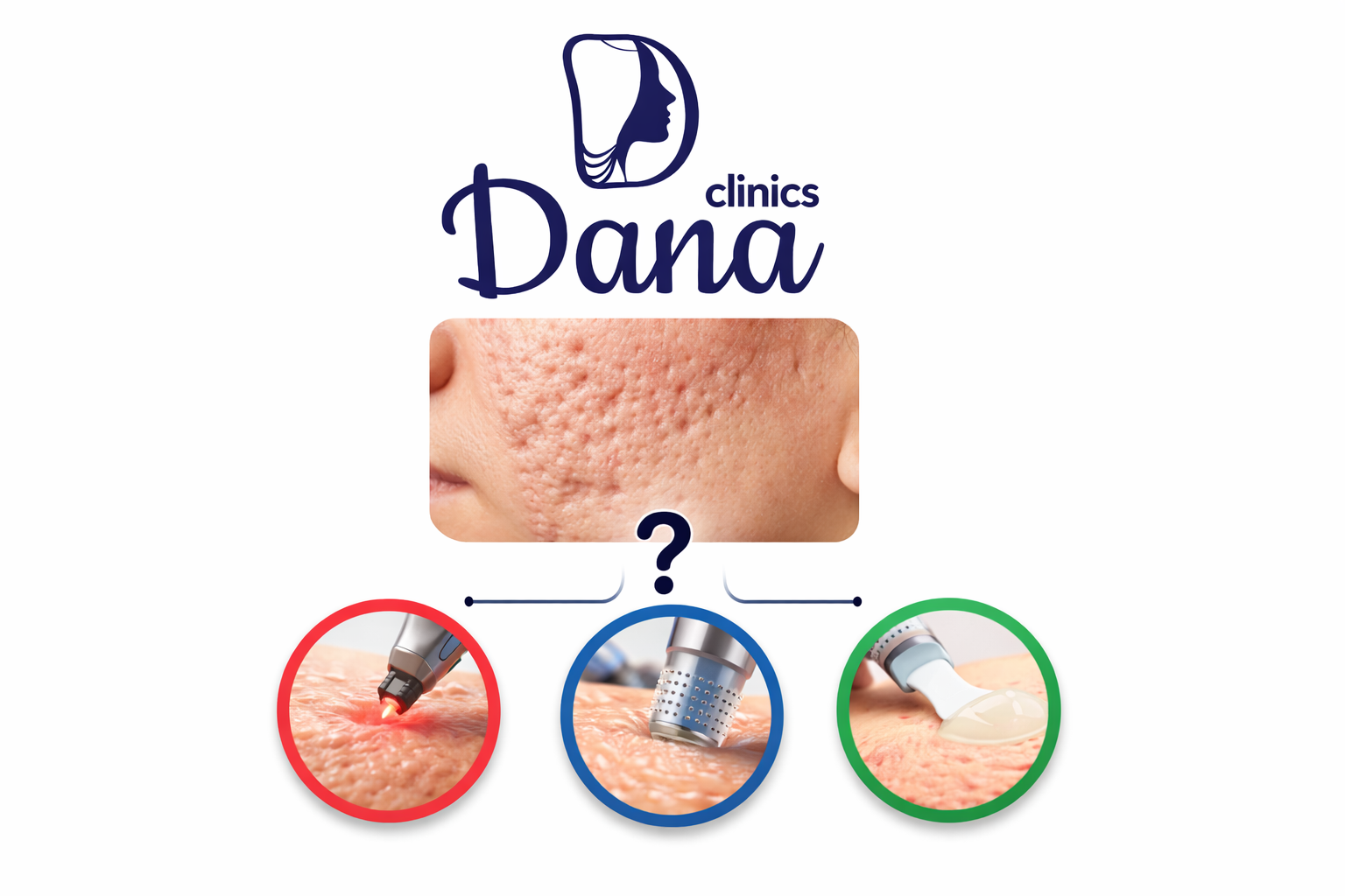 اثار الحبوب (ندبات وحفر): ايه الافضل ليزر ولا ميكرونيدلينج ولا تقشير؟ دليل اختيار العلاج